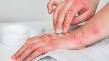 UYUZ 15 DAKİKA SONRA BULAŞIYOR