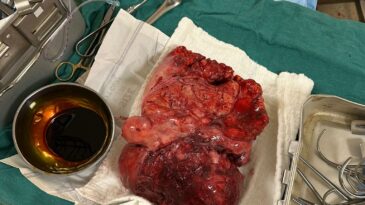 TÜMÖR BAŞARIYLA ÇIKARILDI