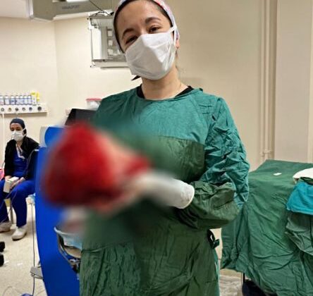 DEV GÖĞÜS TÜMÖRÜ ÇIKARILDI